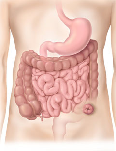 Colostomía sigmoidea 